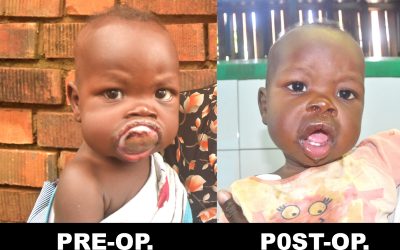 Bild av Timothy före och efter operation